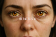 © sweasy - Die gelben Augen einer Frau mit Hepatitis A, Lebererkrankung
