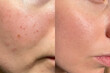 © Vikto - Close-up skin comparison showing acne scars, enlarged pores, and smoother results after treatment. Ideal for skincare, dermatology, and cosmetic product promotion.