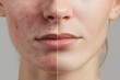 © Sathaporn - Close-up comparison of woman's face before and after acne treatment showing skin improvement and clarity.