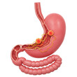 © Rubi - Isolated Illustration Of Human Stomach Anatomy Affected With Cancer and Disease