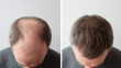 © mariiaplo - A comparison of a balding man's head on the left and a fuller head of hair on the right. Both images show the same man with gray hair and a neutral expression.