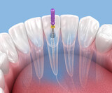 Endodontic root canal treatment process. Medically accurate tooth 3D illustration.