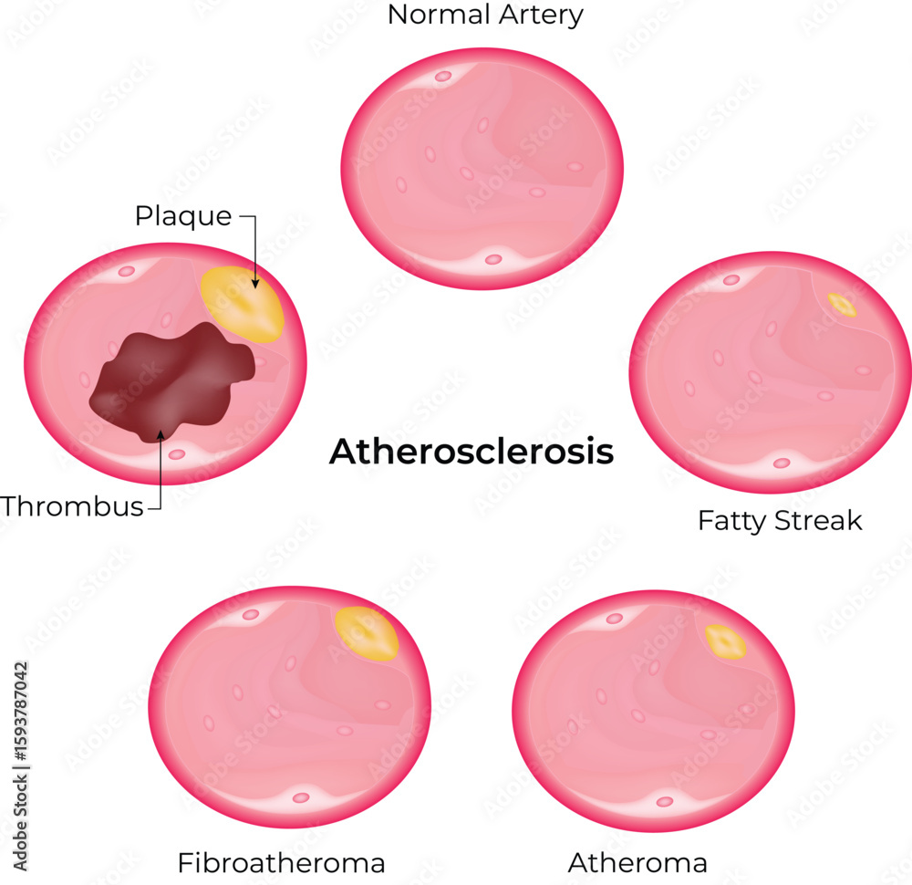 Atherosclerosis Stages of Artery Plaque Buildup Vector Illustration ...