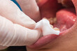 © Mdv Edwards - Dental professional wipes the patient's gums and lower lip with gauze after oral prophylaxis to remove debris and excess paste.