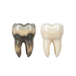 © ThomasR - Isolated 3D Illustration of Clean and Decayed Tooth