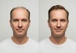 © Kristina - Man before after hair restoration process. Hair loss treatment concept for baldness solution and hair regrowth.