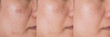 © Praewphan - cropped Image before and after spot melasma pigmentation treatment on skin face asian woman compare in 3 development periods. Skincare and beauty concept
