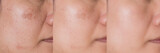 cropped Image before and after spot melasma pigmentation treatment on skin face asian woman compare in 3 development periods. Skincare and beauty concept