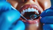 © skypiercer - Close-up of patient's open mouth, blue gloved hands holding dental tools, focused on teeth