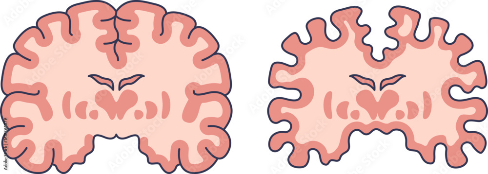 Illustration comparing a healthy brain cross-section to one with ...
