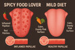 © sakson - Comparing tongue health spicy food lover vs mild diet infographic analysis health education visual comparison