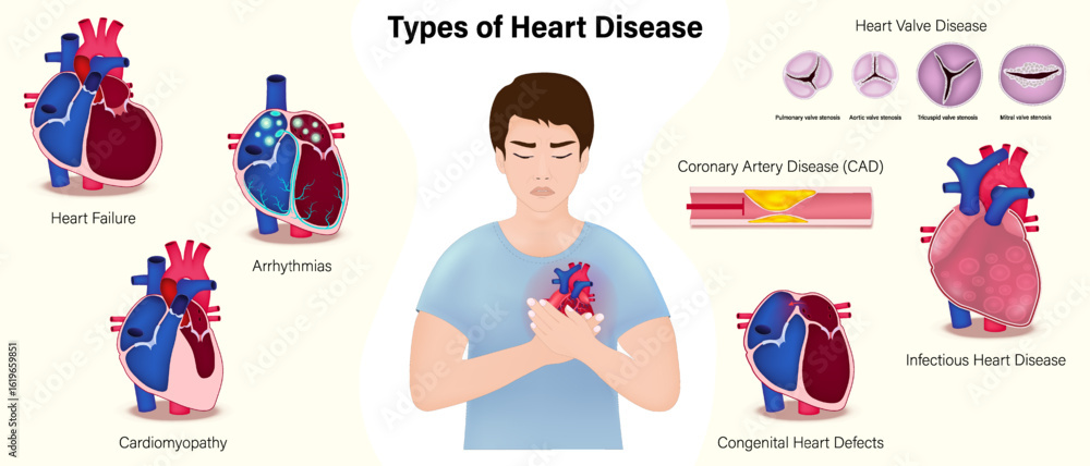 Types of heart disease vector. Heart Failure, Arrhythmias ...
