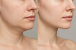 © foto Art - Double chin reduction and lower jaw contour enhancement before after comparison, right profile, bright neutral background, cosmetic surgery concept