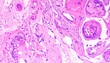 © Abu Hamzah Musa - Microscopic view of a biological tissue sample showing cellular detail and concentric calcifications. Histology slide for scientific study.