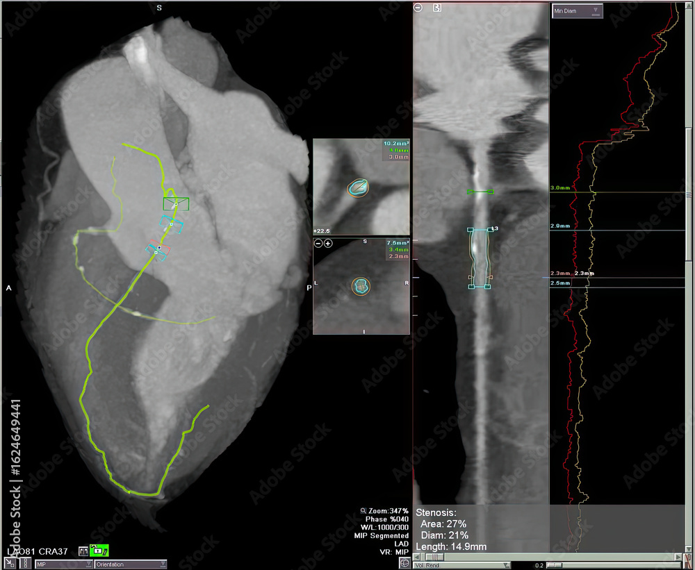 Heart Medical Scan Heart CT scan examination screen display, reconstruction Showing Severe ...