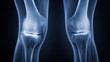 © Arpatsara - This image shows an X-ray of two human knees, highlighting bone structure and joint details in a detailed, monochromatic view.