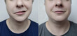 © Siniehina - Before and after comparison of a young person with facial nerve palsy (Bell’s palsy). Concept of neurology, recovery, treatment success, and medical