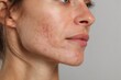 © Shelly - Closeup of a womans face shows her facial skin texture pores acne scarring and several red blemishes