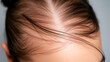 © Desiree - Close up thin hair on scalp of head woman.