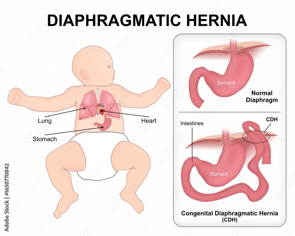 Congenital Diaphragmatic Hernia (CDH) Stock Illustration | Adobe Stock