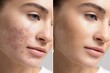 © Виктория Марьенко - Face skin close up shows blemishes disappear before after effective clear healthy skin treatment