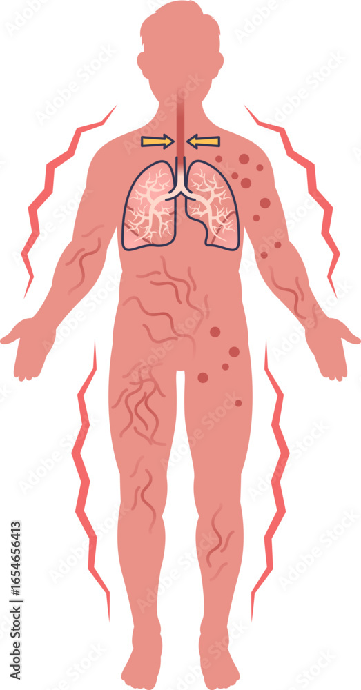 Medical illustration of systemic anaphylaxis symptoms. Shows a human ...