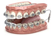 © shahbaztan - Anatomical model showing teeth with braces and wires for orthodontic treatment and dental alignment created with generated ai