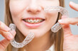 © Михаил Решетников - Woman with braces on her teeth holding and removable transparent aligners.