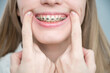 © Михаил Решетников - Close-up of a young woman's smile with metal braces on her teeth. Correction of bite