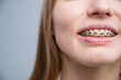 © Михаил Решетников - Close-up of a young woman's smile with metal braces on her teeth. Correction of bite