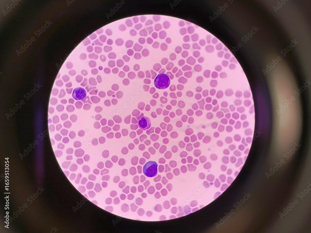 Microscopic view of blood pathology showing abnormal cells. Medical ...
