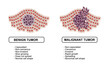 © Perupailustrator - Vector illustration of malignant and benign tumors in body tissues. Difference between malignant and benign tumors, Spread of cancer cells. Medical vector illustration for education, posters, clinics,