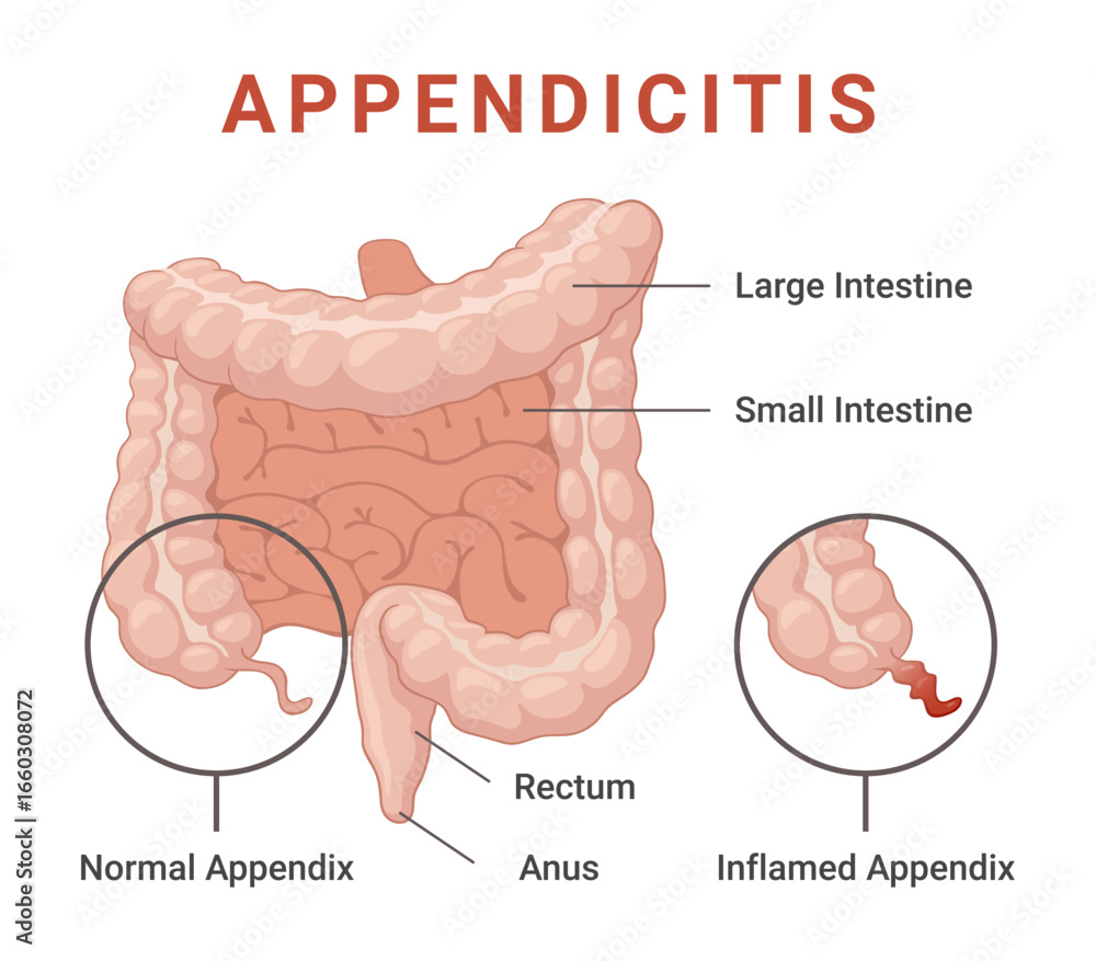Illustration of an inflamed appendix as seen in appendicitis, showing ...