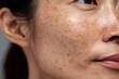 © LimeSky - Close up of an Asian woman s face showing freckles enlarged pores blackheads and scars due to neglect Soft focus on skin issues Treatment and skincare theme