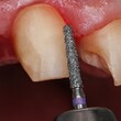 © Nadia - Close-up of dental crown preparation with diamond bur drill on front tooth, enamel reduction process for prosthetic restoration