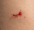 © studybos - A red mark on a person's arm