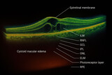 OCT Scan Showing Cystoid Macular Edema and Epiretinal Membrane - Illustration