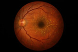 Retinal Fundus with Drusen: Illustration of Age-Related Macular Degeneration (AMD)