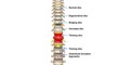 © SAYERA - Human spine with degenerative disc disease and herniated disc illustration