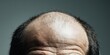 © Simon - Mature caucasian male with balding head and receding hairline on forehead