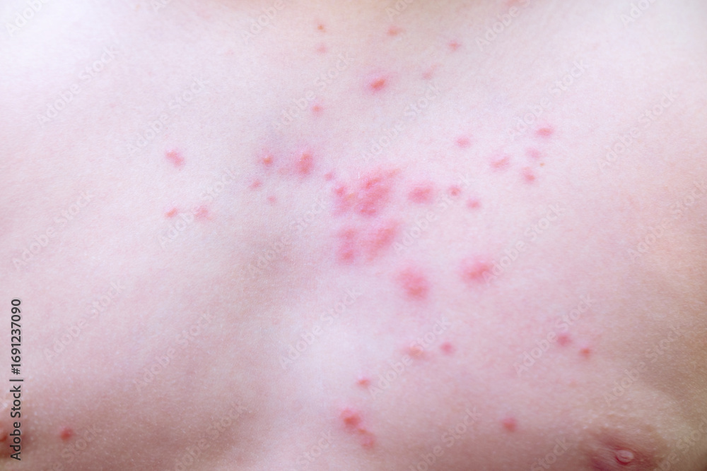 human skin covered in red, itchy rash, 11-year-old child with rash on ...