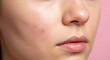 © Dora - Close-up of a persons face with a blemish.