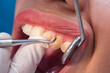 © Mdv Edwards - A detailed close up shot showing a dentist meticulously scraping plaque and tartar off the tooth surface while working in a modern dental clinic setting.