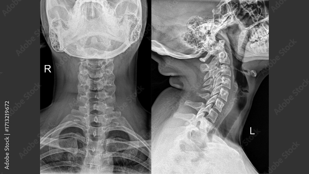 X-ray of cervical spine showing native vertebral anatomy – AP and ...