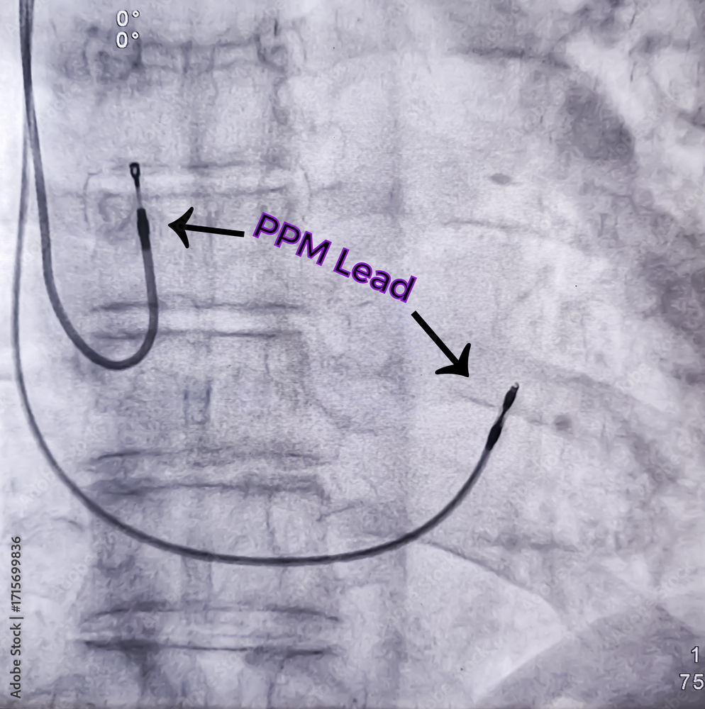 X ray image showed dual chamber permanent pacemaker (PPM) leads in left ...
