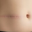 © sela - Abdominal Scar, Close-up, Light Skin Tone.