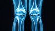 © Saree - X-ray image of human knee joints and bones.