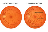 Comparison of a healthy retina and a diabetic retina, illustrating the effects of diabetes on eye health with labels for microaneurysms, hemorrhages, and neovascularization.