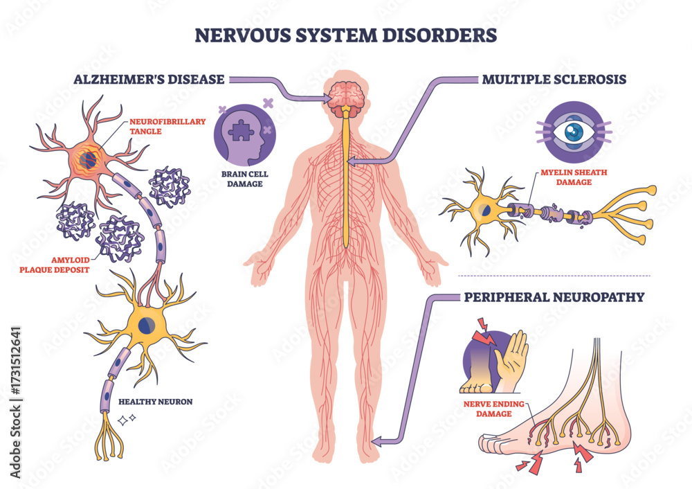 Nervous system disorders are illustrated with labeled diagrams of ...