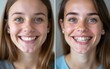 © zhao - Closeup shot of young woman before and after dental braces, two years apart. High quality